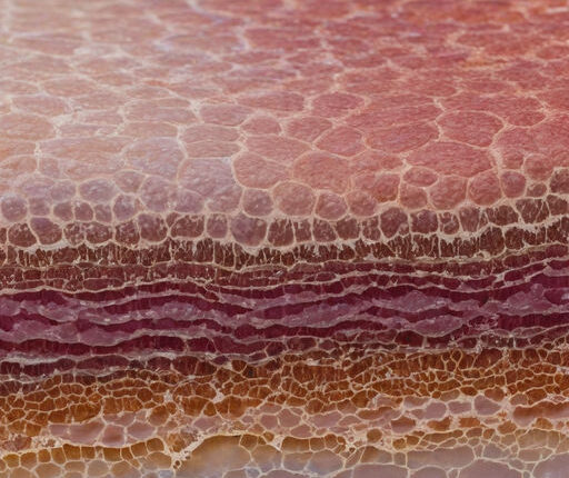 close up view of the spectrum of skin patches caused by tinea versicolor showcasing various shades